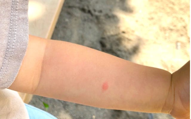 赤ちゃんの虫刺され